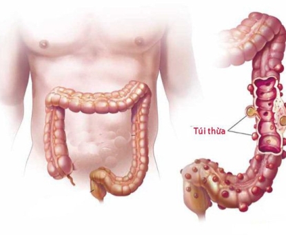 Táo bón và bệnh túi thừa đại tràng: Nguy cơ và cách phòng tránh